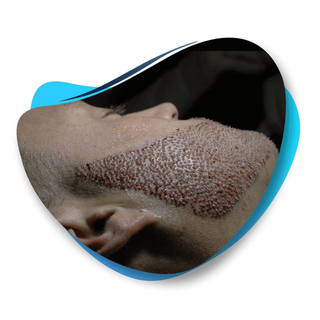 GREFFE DE BARBE TURQUIE