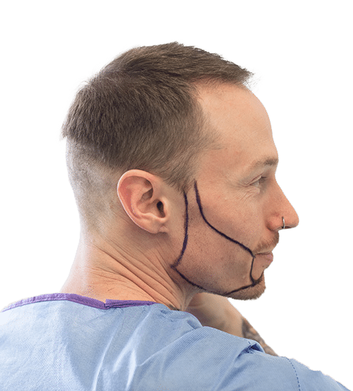 Beard Transplant France - Patient français