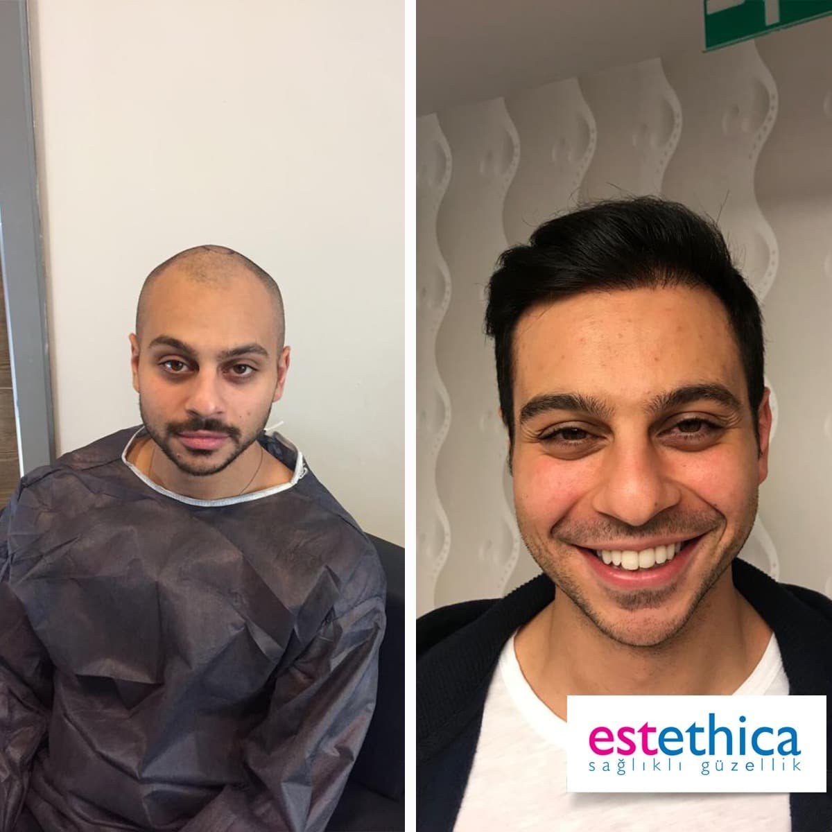 Greffe de barbe Istanbul résultat