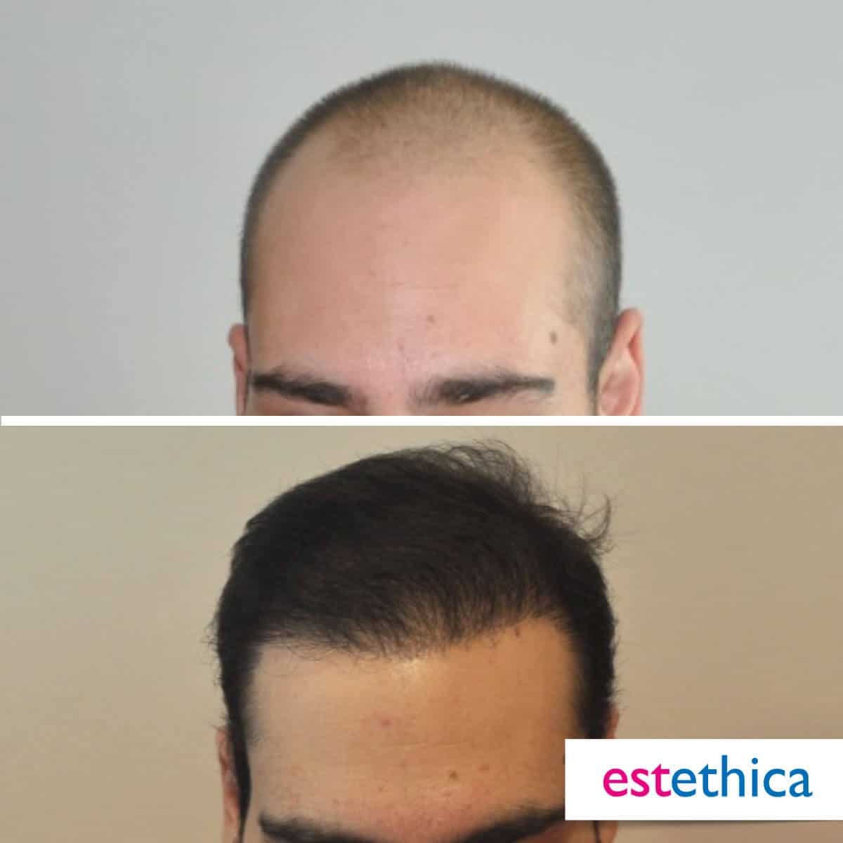 Greffe de barbe résultat - Avant Après