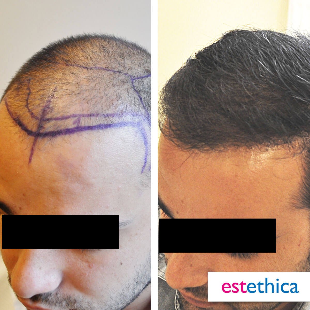 Greffe de barbe moustache