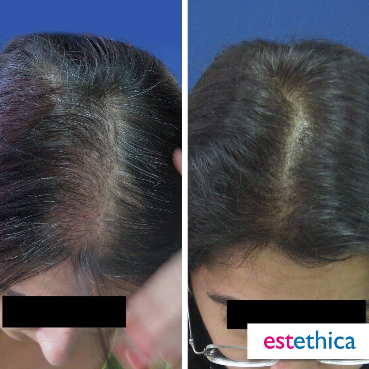 Greffe de barbe densification