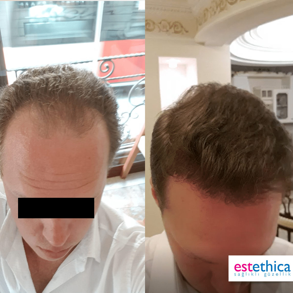 Greffe de barbe Turquie avant après