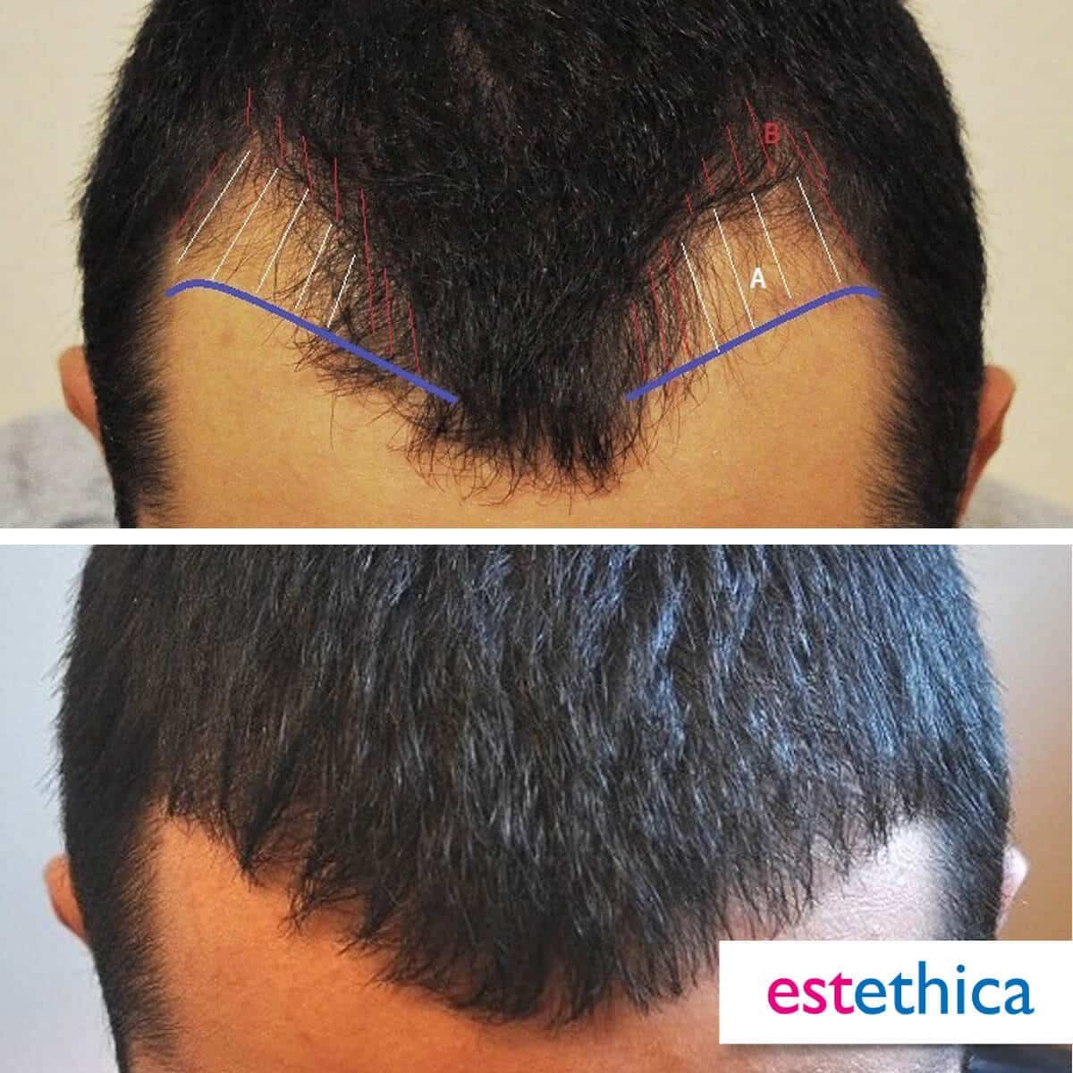 Greffe de barbe résultat final