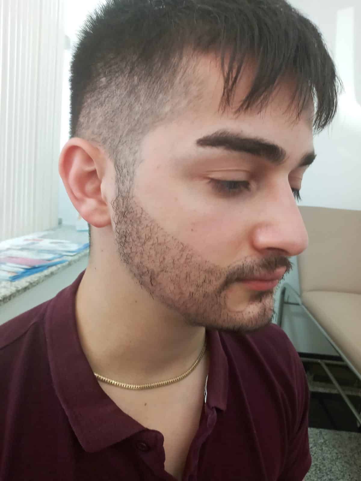 Greffe de barbe Istanbul - Témoignage patient